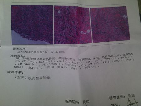 乳腺癌转移肝挂什么科