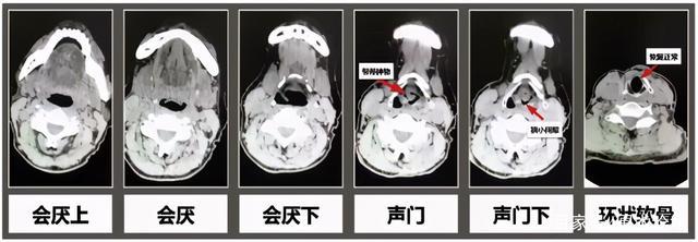 什么是声带囊肿
