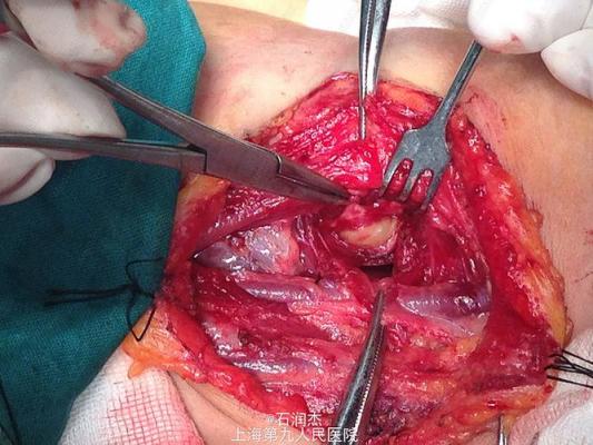 什么是声带囊肿