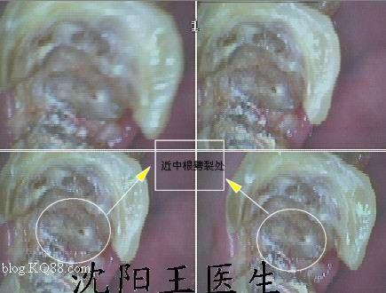 牙齿上有血块怎么办