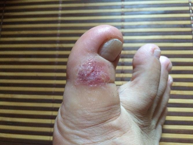 脚气出水是什么原因