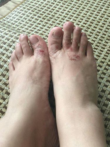 脚气出水是什么原因